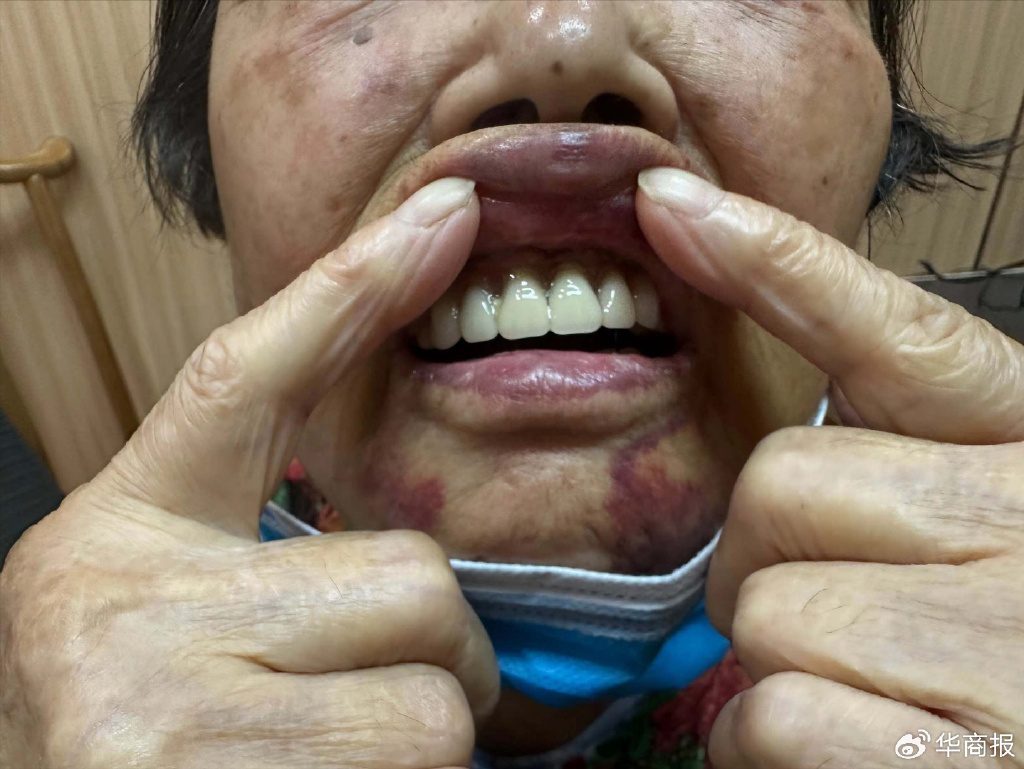 老人看牙遭全口拔光 医院被顶格处罚